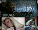 SUTURES